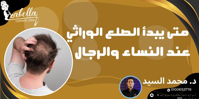 متي يبداء الصلع الوراثي