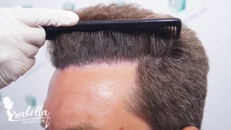 Hair transplantation on the frontal line