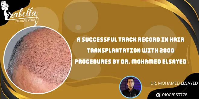 A successful track record in hair transplantation with 2800 procedures by Dr. Mohamed Elsayed
