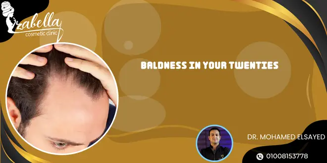 Baldness in your twenties