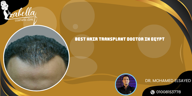 Best hair transplant doctor in Egypt