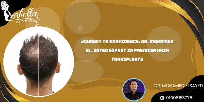 Journey to Confidence: Dr. Mohamed El-Sayed Expert in Premier Hair Transplants