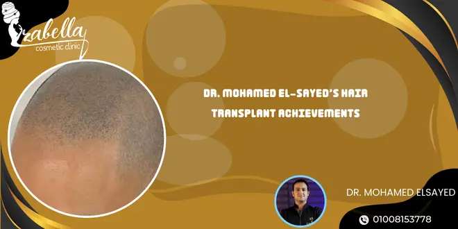 Dr. Mohamed El-Sayed’s Hair Transplant Achievements