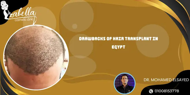 Drawbacks of Hair Transplant in Egypt