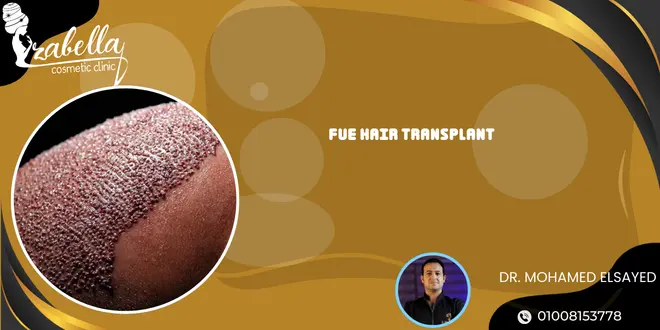 FUE hair transplant