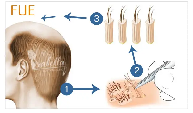 FUE (Follicular Unit Extraction) technique