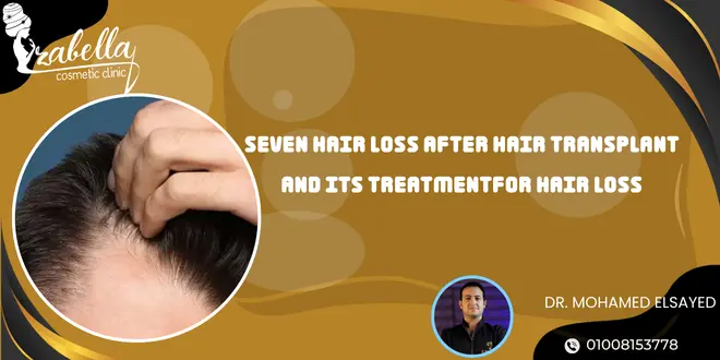 Hair loss after hair transplant and its treatment