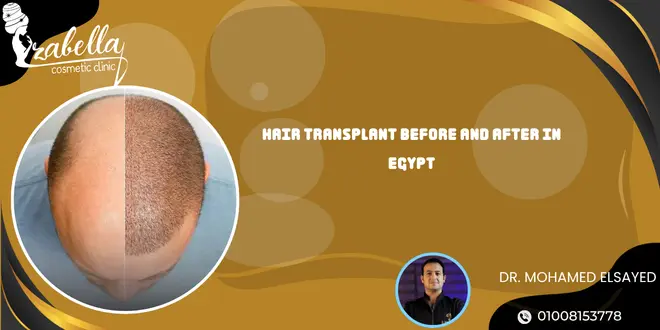 Hair transplant before and after in Egypt