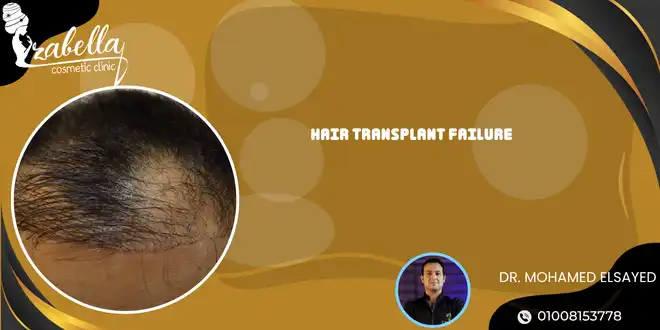 Hair transplant failure