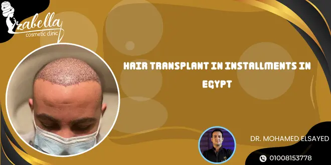 Hair transplant in installments in Egypt