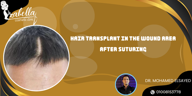 Hair transplant in the wound area after suturing
