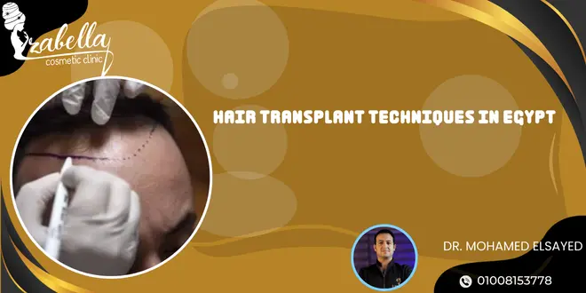 Hair transplant techniques in Egypt