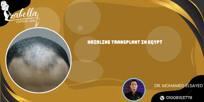 Hairline transplant in Egypt