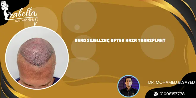 Head swelling after hair transplant