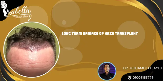 Long-term damage of hair transplant