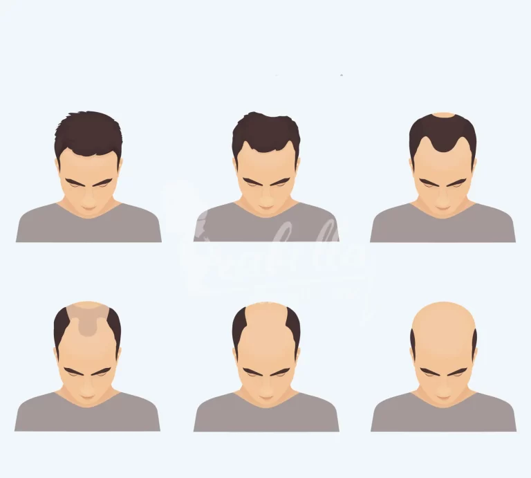 Stages of hair loss