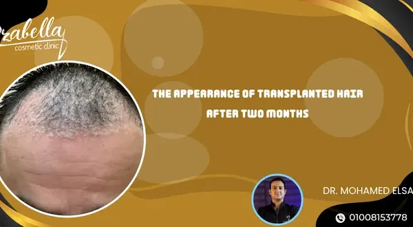 The appearance of transplanted hair after two months