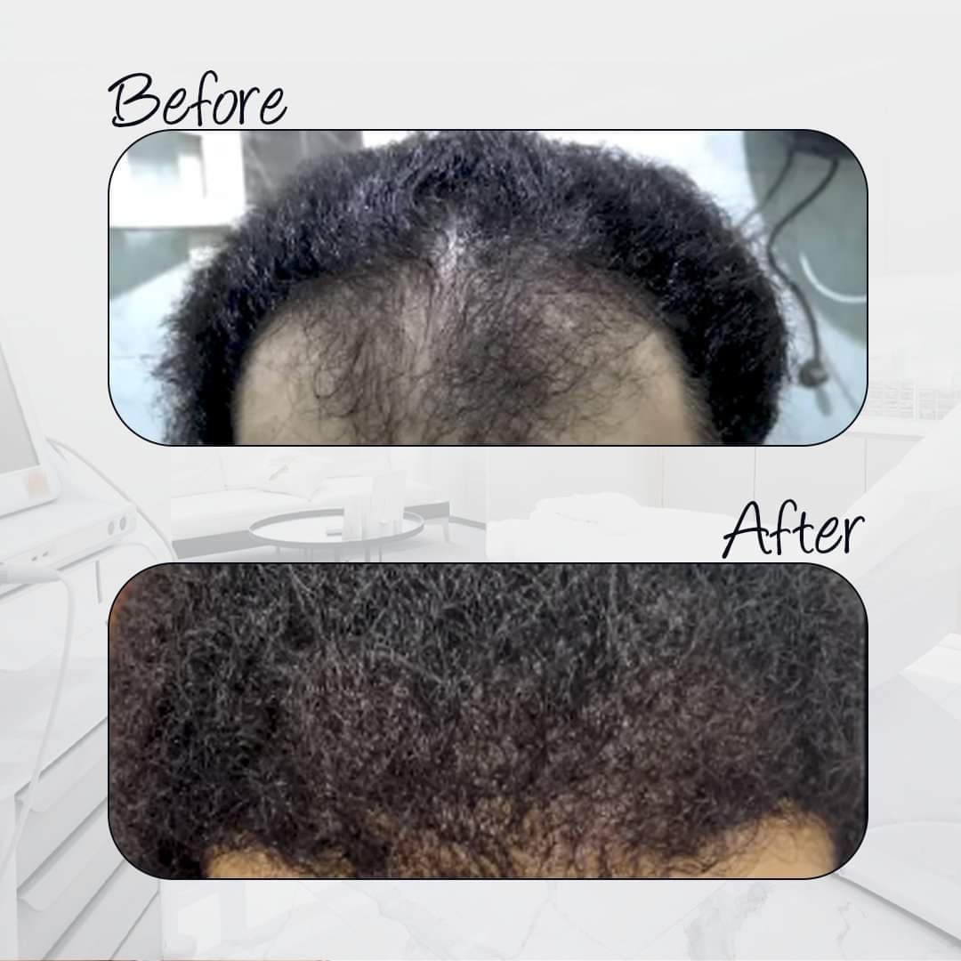 Who has tried hair transplantation in Egypt