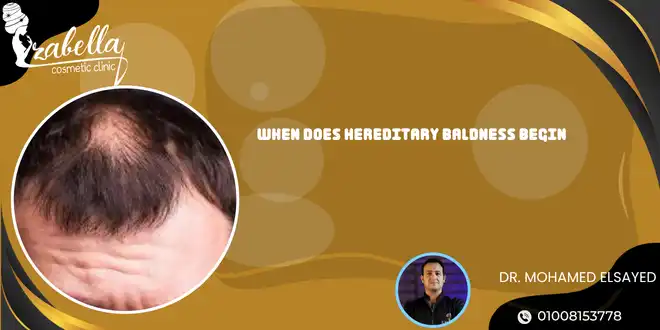 When does hereditary baldness begin