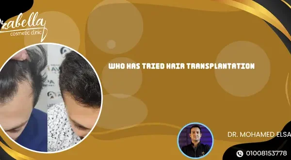 Who has tried hair transplantation