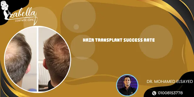 hair transplant success rate