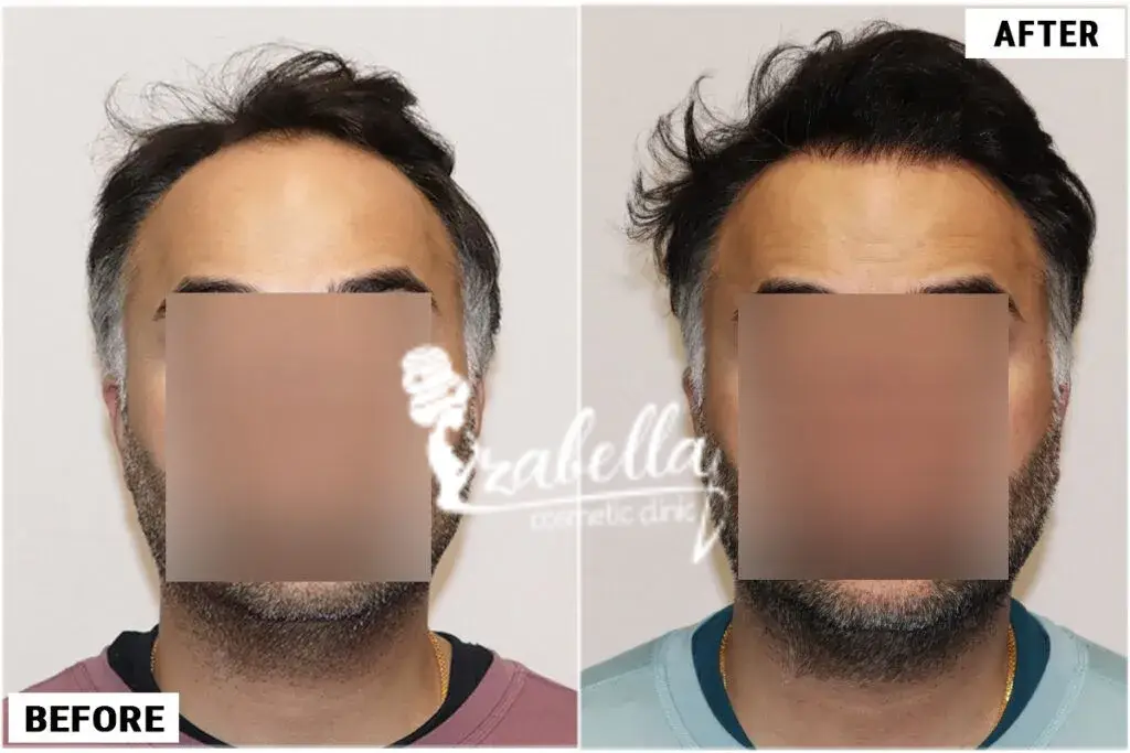 Post hair transplant