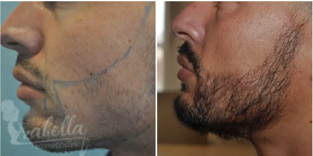 Steps for beard transplantation