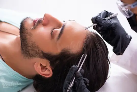 Best hair transplant doctor in Egypt