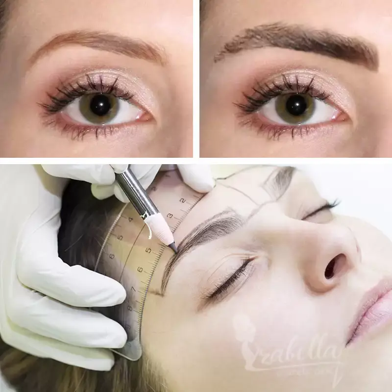 DHI eyebrow transplant