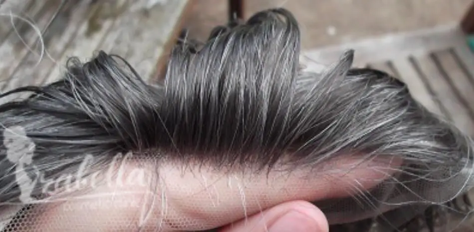 My experience with artificial hair transplantation