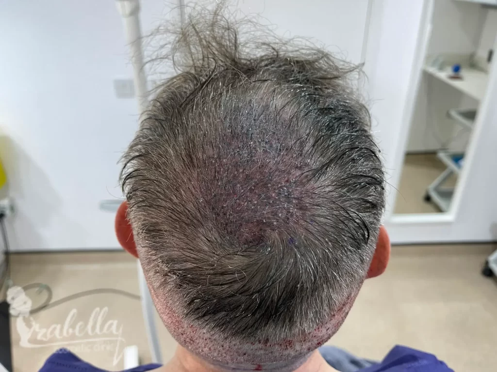 Hair transplant without shaving