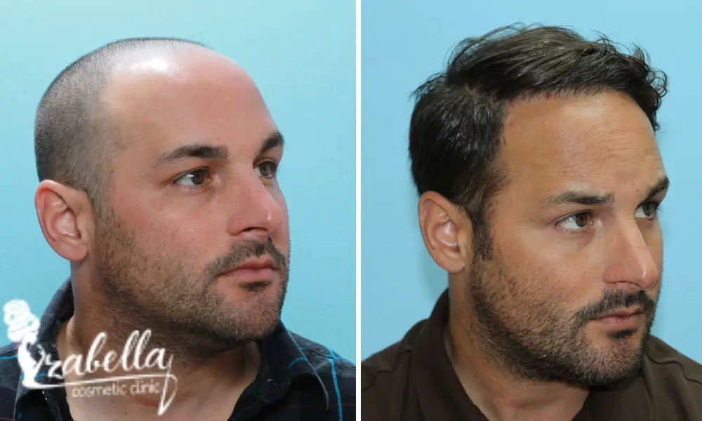 Hair transplant before and after