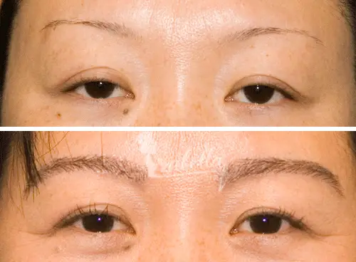 DHI eyebrow hair transplant