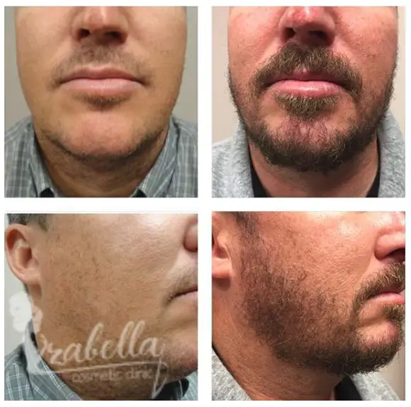 Hair transplantation in chin gaps