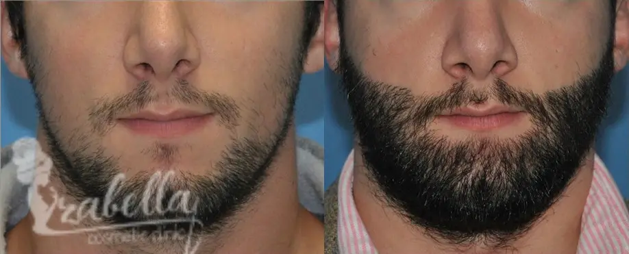 Beard gap implants