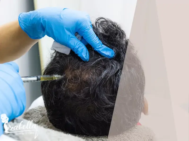 Hair loss treatment in Egypt