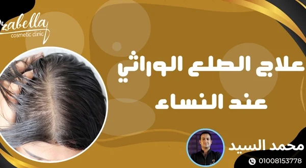 علاج الصلع الوراثي عند النساء