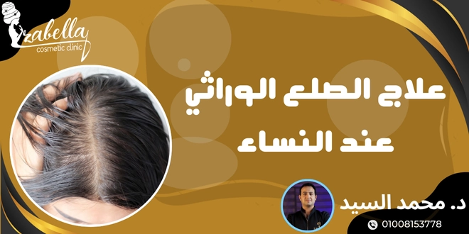 علاج الصلع الوراثي عند النساء