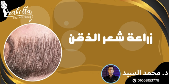 زراعة شعر الذقن
