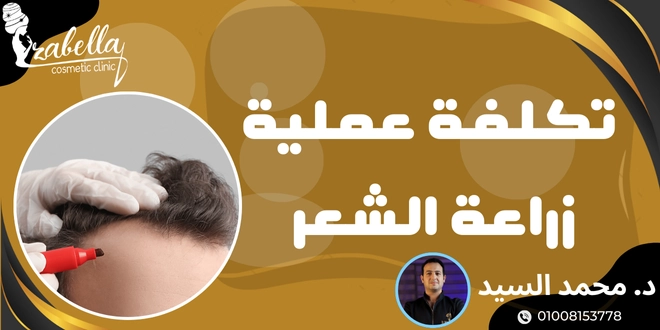 تكلفة زراعة الشعر