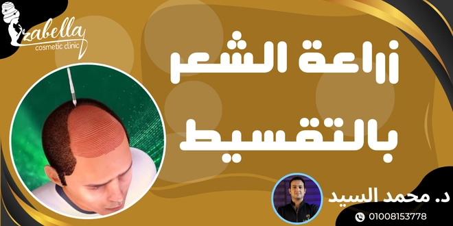 عيادات زراعة الشعر للرجال