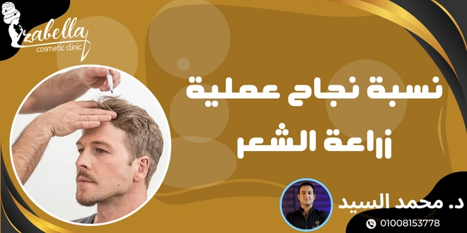 نسبة نجاح عملية زراعة الشعر
