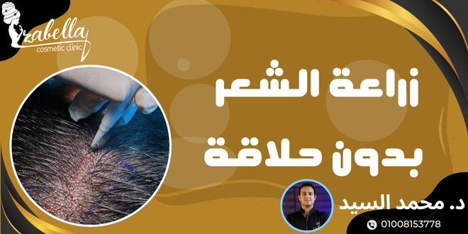 زراعة الشعر بدون حلاقة