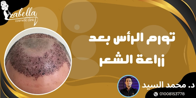 تورم الرأس بعد زراعة الشعر