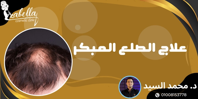 علاج الصلع المبكر