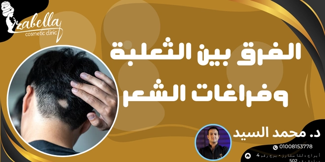 الفرق بين الثعلبة وفراغات الشعر