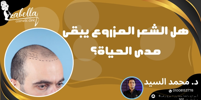 هل الشعر المزروع يبقى مدى الحياة