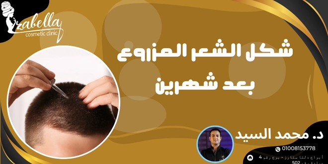 شكل الشعر المزروع بعد شهرين