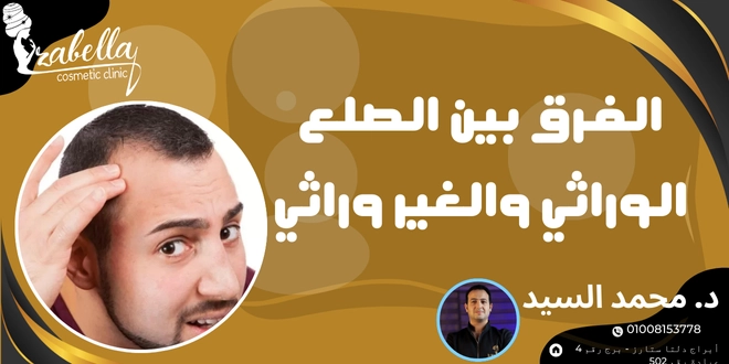 الفرق بين الصلع الوراثي والغير وراثي