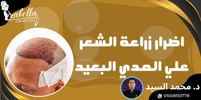 أضرار زراعة الشعر على المدى البعيد
